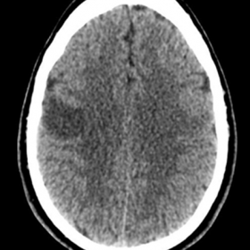 Axial non contrast-enhanced CT of the head shows hypoattenuating area in the right cortico-subcortical frontal region