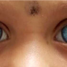 Clinical picture showing blue colour of both iris.