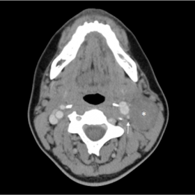 Contrast-enhanced computed tomography in the axial plane shows a slightly heterogeneous, well-defined solid lesion in the lef