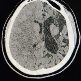 Computed Tomography ( CT) axial section showing diffuse left cerebral atrophy with prominent sulcal spaces and dilated left l