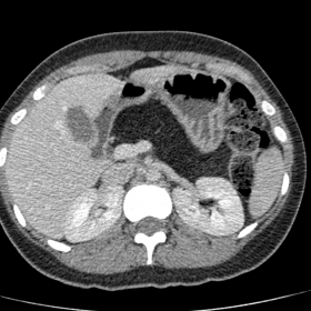 Contrast-enhanced CT scan. Uniformly low attenuation of the pancreatic body and tail, which has the same attenuation as the s