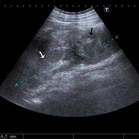 US longitudinal image of the left flank shows a heterogeneous hyperechoic collection (black arrow) adjacent to the lower half