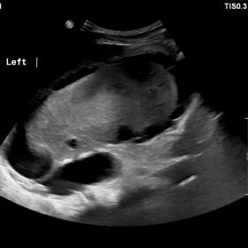 Left Kidney Ultrasound showing a perinephric anechoic cystic lesion surrounding the left kidney