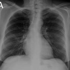 chest x-ray, postero-anterior (A) and lateral (B) projections. No salient abnormalities were identified at the moment of acqu