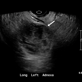 Transvaginal grayscale ultrasound demonstrates an enlarged left ovary (arrow) measuring up to 6.2 cm with numerous hypoechoic