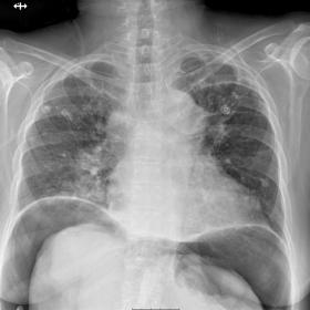 Upright chest x-ray at day 2 of admission. Massive pneumoperitoneum as infra-diaphragmatic gas density crescents