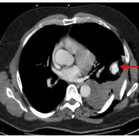 CT scan with intravenous iodinated contrast, in axial, coronal and sagittal planes, shows the enhanced left-sided pseudoaneur
