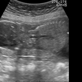 Antenatal ultrasonography showing dilated trachea with cut-off at the upper end. Along with bilaterally enlarged echogenic lu