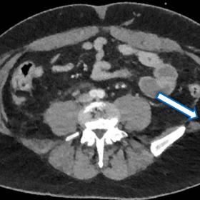 Trauma protocol CT whole body, arrow shows abdominal wall lumbar herniation