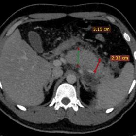 Bulky body and tail of pancreas with peripancreatic fat stranding and irregular outline