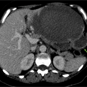 Axial image shows a voluminous hepatic mass, occupying all the left lobe. Notice internal density heterogeneity, with hyperde