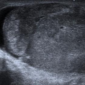 US scan reveals enlarged, heterogenic right testicle and epididymis with minimal