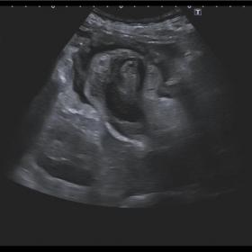 Ultrasound image centered in the gallbladder shows  thickenned wall with different echogenicity layers and partly filled with