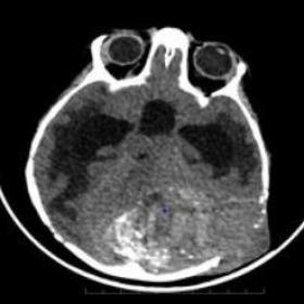 Plain CT and CECT brain Axial images (brain window) show a fairly well defined lobulated heterogeneously enhancing soft tissu