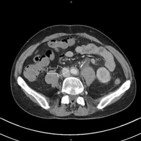 Enhanced CT scan demonstrated hypodense, homogeneous, circumferential and diffuse wall thickening of the infra-renal abdominal