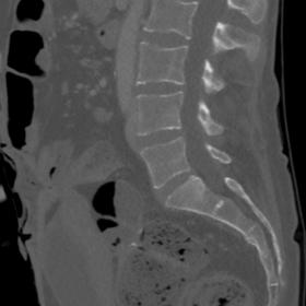 Sagittal view demonstrating an irregular shaped high density area involving more than a half of the T11 vertebral body with a
