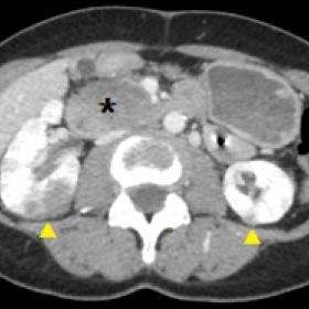 Contrast enhanced CT venous phase, axial plane. An oval shaped, well circumscribed mass is seen in the head of the pancreas (
