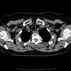 Axial CT images through the upper trachea in the soft tissue (a), lung (b) and bone (c) windows show multiple non-calcified n