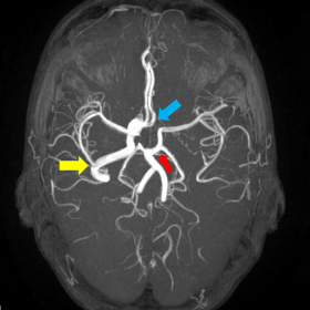 MRA brain showing the right internal carotid artery (yellow arrow). The left internal carotid artery is absent in this picture. Hypertrophic anterior communicating artery supplying the left anterior cerebral artery is shown (blue arrow)