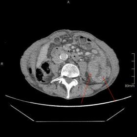 IV contrast-enhanced CT of the abdomen (Axial Plane) demonstrating a submucosal gastric mass (red arrow)