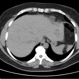 CT without contrast shows a lesion in the segment II of the left liver lobe, homogeneously hypodense