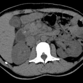 Axial non-enhanced CT, showing a hyperdense calculus impacted on the minor papilla with ascending ductal dilatation. Notice a