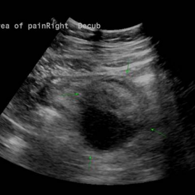 In the area of pain in the left upper quadrant, there is a 5 cm well-defined, non-mobile, anechoic cystic mass (arrows) with 