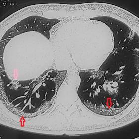 HRCT chest (axial section) obtained during COVID-19 infection showing features of covid pneumonitis as peripheral and subpleu