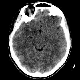 Axial non-contrast CT slice, showing subtle right medial temporal lobe hypodensity
