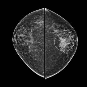 Bilateral mammogram in (a) CC and (b) MLO views. Focal asymmetry was detected in the upper central part of left breast, corre