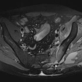 Selected MRI images show effusion of the left sacroiliac joint associated with extensive periarticular bone marrow edema, soft tissue edematous changes seen as low T1, high T2/PD signal in surrounding muscles, and multiple fluid collections located in the thickness of gluteus maximus, piriformis, erector spinae, and iliac muscles. The largest collection which dissects the gluteus muscle fibers and reaches the subcutaneous fat plane, arises from the posteroinferior aspect of the sacroiliac joint (1a, arrow)