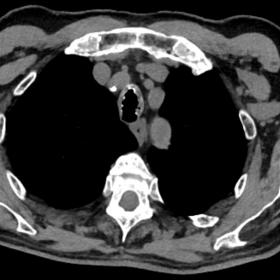 Axial CT reconstruction in mediastinal window showing irregular thickening of the anterolateral tracheal wall with multiple n