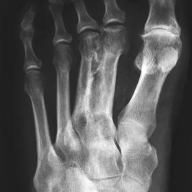 Plain radiographs of left foot in the anteroposterior (AP) view. Severe osteoarthritis in 1st MTPJ