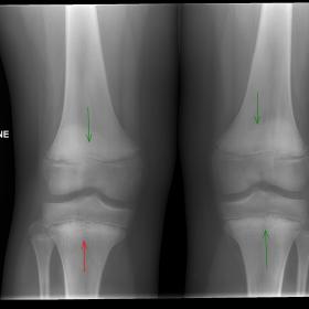 X-Ray AP view of bilateral knees