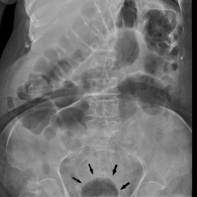 On the abdominal plain radiography, oval-shaped gas lucent areas superposed to the pelvic level were observed (black arrows)