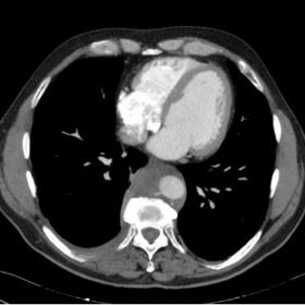 CT angiography of the pulmonary arteries in an axial plane reveals a soft tissue mass enveloping the descending aorta. The po