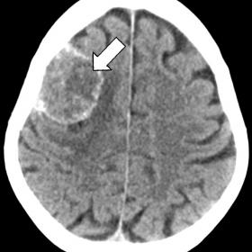 Axial pre- and post-contrast images (A&B). There is an extra-axial mass in the right frontal region with ill-defined hypoatte