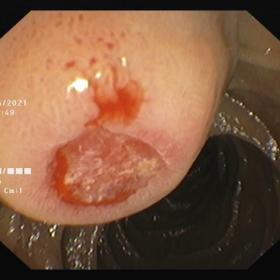 Upper GI scopy shows, Polypoidal lesion at 2nd/3rd part of duodenum with surface ulceration and active oozing of blood