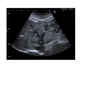Ultrasonographic transversal section of the liver. Multiple focal lesions (*) with a diffuse distribution, mainly hypoechogen