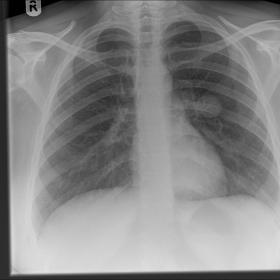 Chest X-Ray with an opacity
