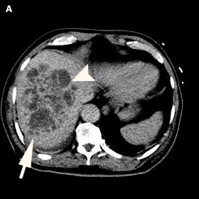 Axial contrast-enhanced CT demonstrates a large ill-defined hypodense lesion in the right lobe (arrow) of the liver with a cy