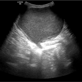 Ultrasound: well-defined hypoechoic lesion with internal echoes