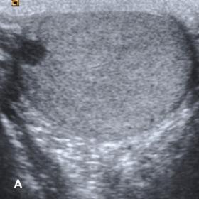 Ultrasound images of the right (A) and left (B) testicles show homogeneously hypoecoic and well-circumscribed similar nodules