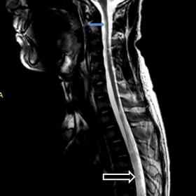 Sagittal MRI spine image shows mild T2 hyperintense signal involving cervical cord (blue arrow). Long segment T2 hyperintensi
