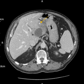Selected contrast enhanced axial, coronal and sagittal CT images showing the presence of a hyperdense foreign body and cystic