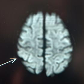 Axial DWI image in neonatal MRI showing subtle high signal at perirolandic cortex (arrow)