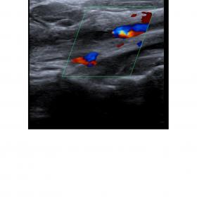 Ultrasound of the neck showing hyperechoic thrombus within the internal jugular vein with the absent flow on doppler study