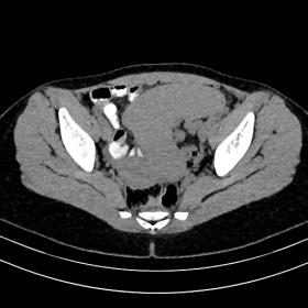 An axial CT image shows a large, well-circumscribed comma-shaped intrapelvic mass which is hypodense on non-enhanced series (