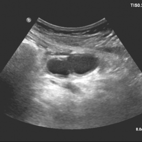 USG of abdomen shows well defined tubular anechoic lesion with multi-layered wall structure in the epigastric region with “