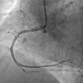 Invasive coronary angiography demonstrating a 95% ostial stenosis of the right coronary artery. Based on this finding, an e